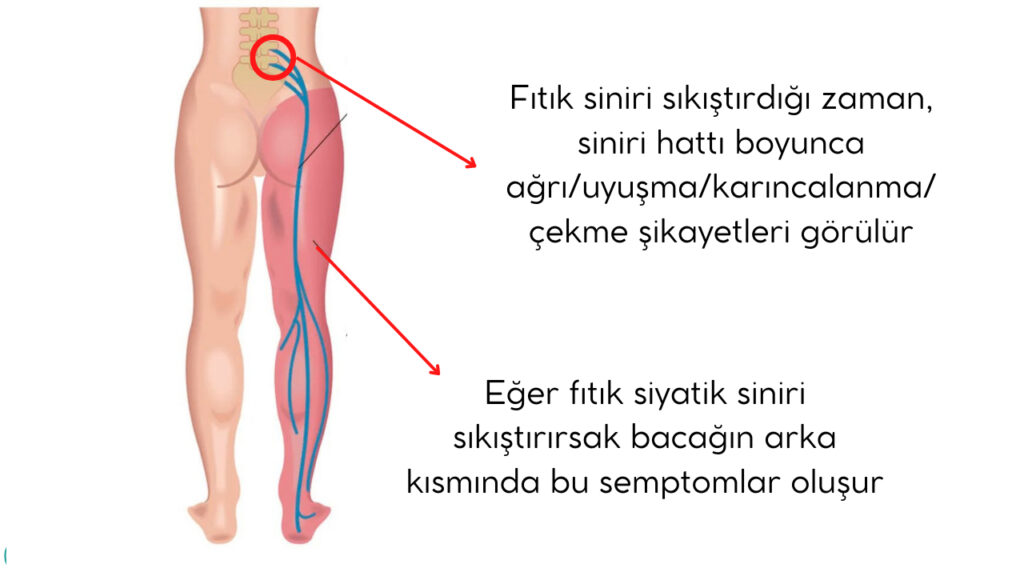 Bel Fıtığı Belirtileri,