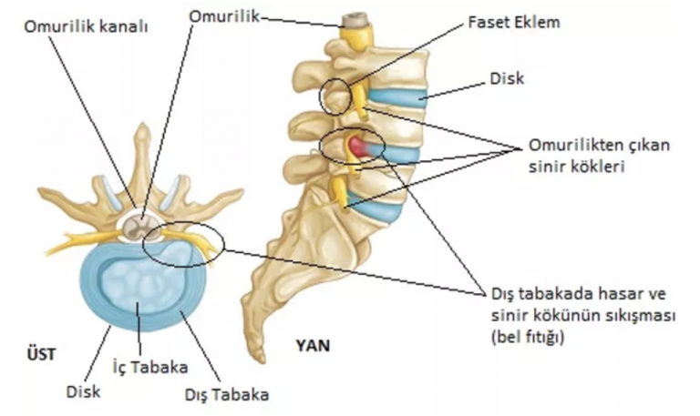 Bel Fıtığı Nasıl Olur